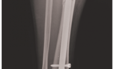 Chấn thương chân và đầu gối